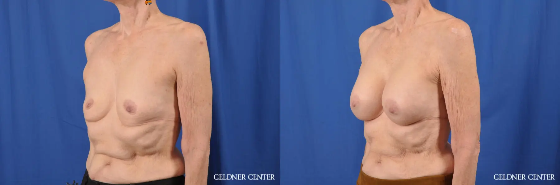 Breast Augmentation: Patient 139 - Before and After 4