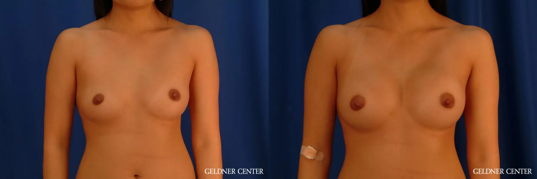 Breast Augmentation: Patient 164 - Before and After 1