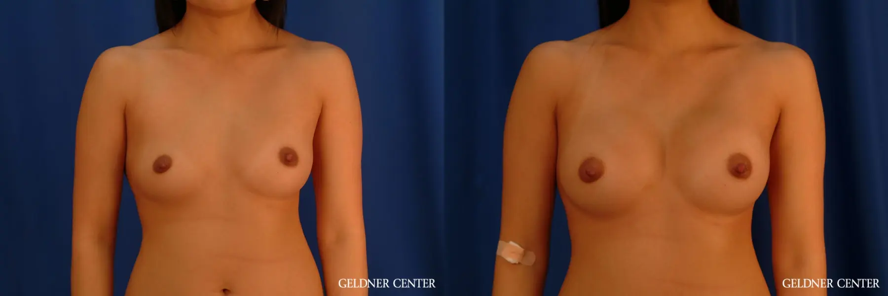 Transaxillary biplanar bubpectoral breast augmentation 300 cc - Before and After