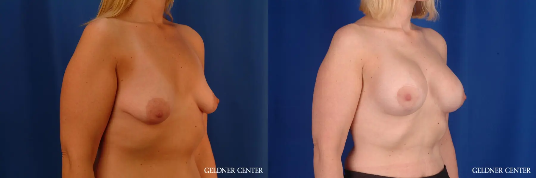 Breast Augmentation: Patient 165 - Before and After 2