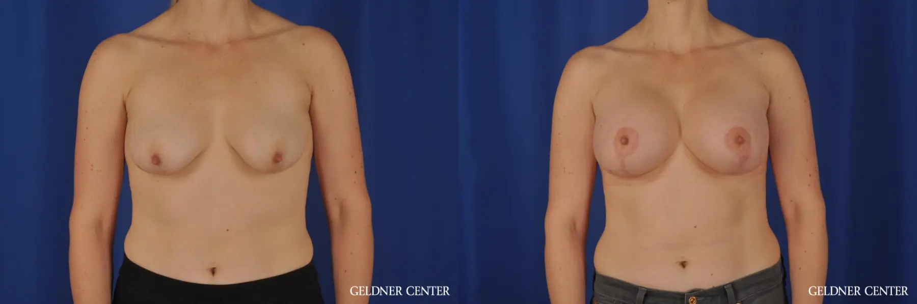 Breast Augmentation Streeterville, Chicago 4288 - Before and After