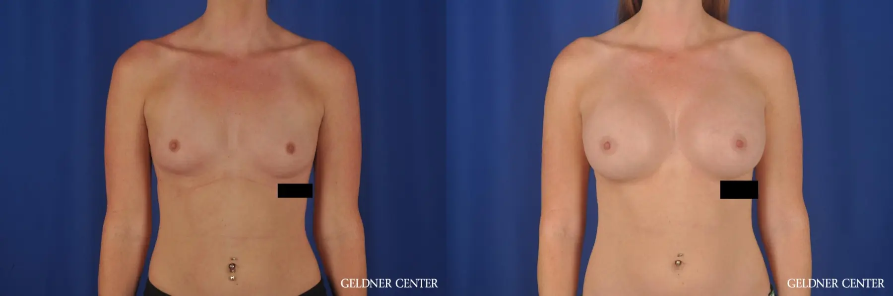 Breast Augmentation Lake Shore Dr, Chicago 6658 - Before and After