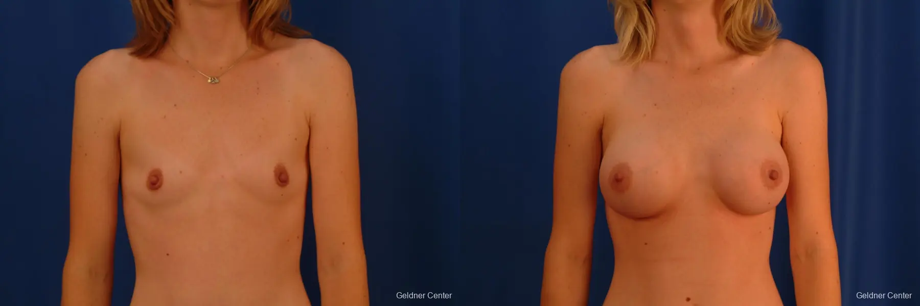 Breast Augmentation Streeterville, Chicago 2530 - Before and After
