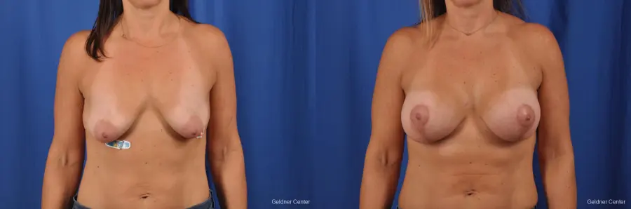 Breast Augmentation: Patient 150 - Before and After 1