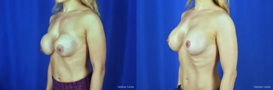Chicago Breast Lift 2072 - Before and After 4