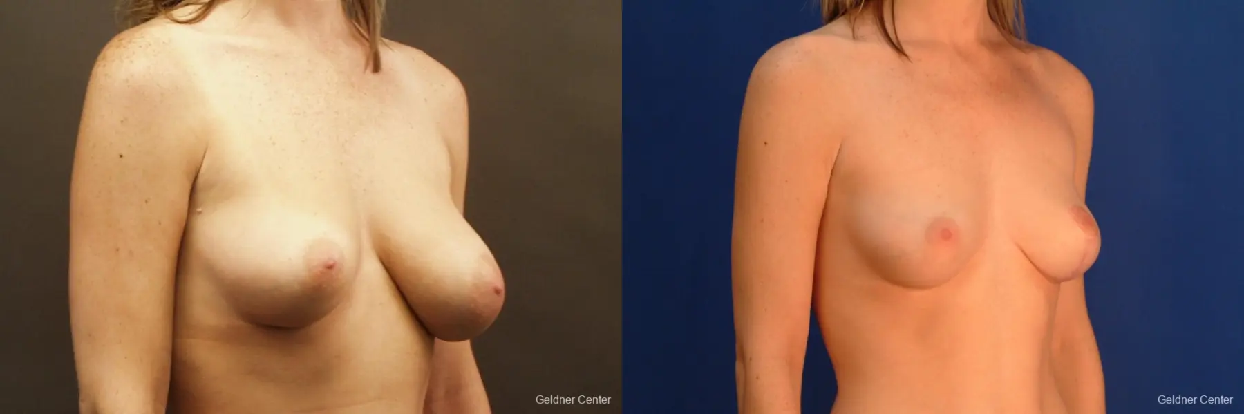 Chicago Breast Lift 2537 - Before and After 3