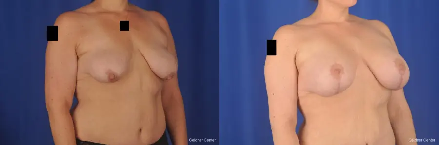 Breast Lift: Patient 18 - Before and After 2