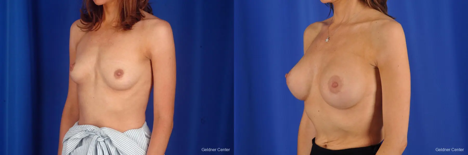 Breast Lift Chicago 2296 - Before and After 5