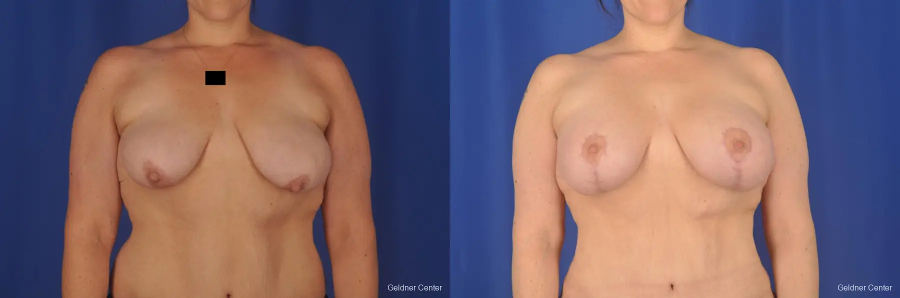 Breast Lift: Patient 18 - Before and After  