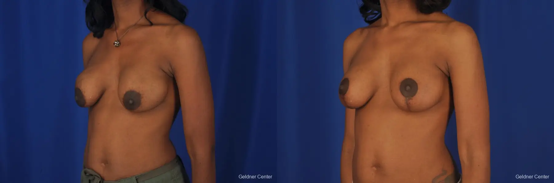 Breast Lift Streeterville, Chicago 2379 - Before and After 3