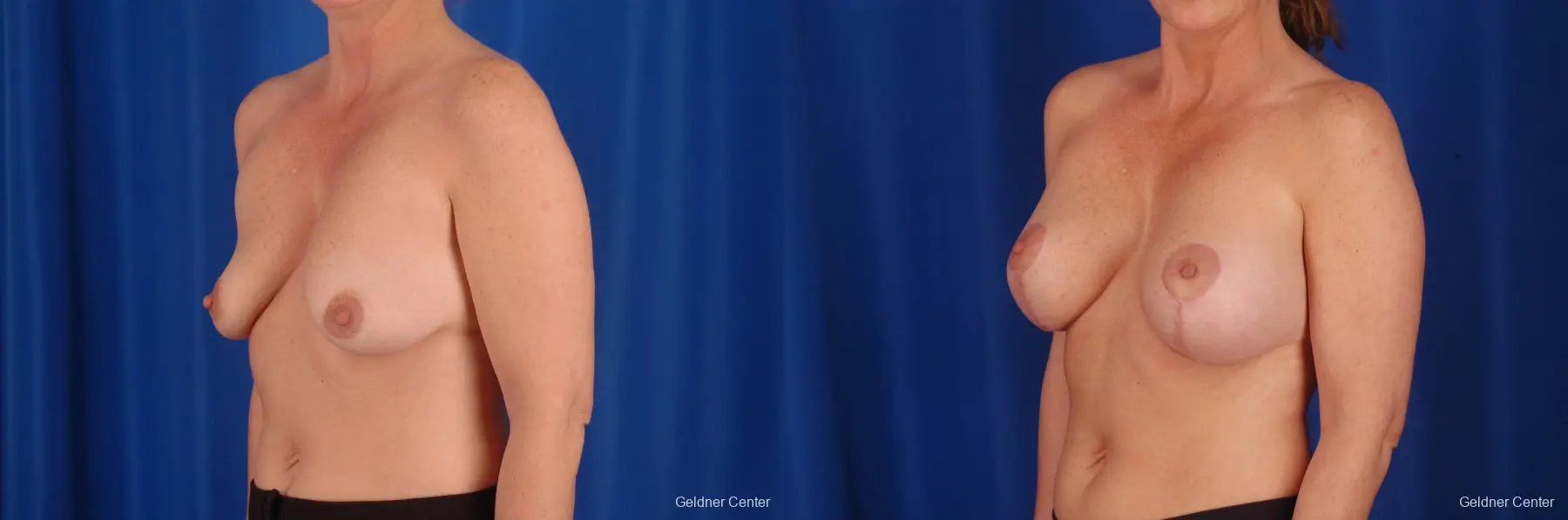 Breast Lift Lake Shore Dr, Chicago 2308 - Before and After 4