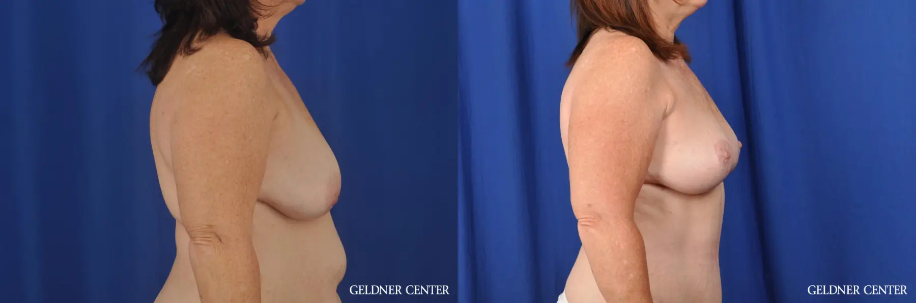 Breast Lift Hinsdale, Chicago 3232 - Before and After 2