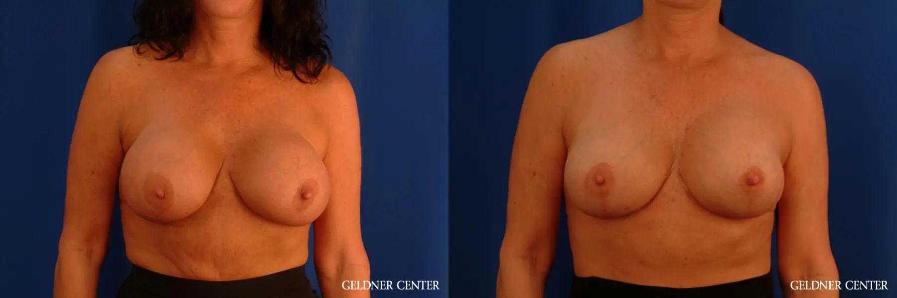 Chicago Breast Lift 2617 - Before and After 1