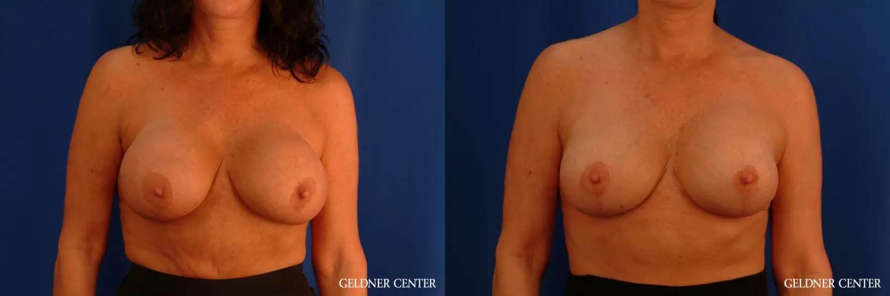 Chicago Breast Lift 2617 - Before and After