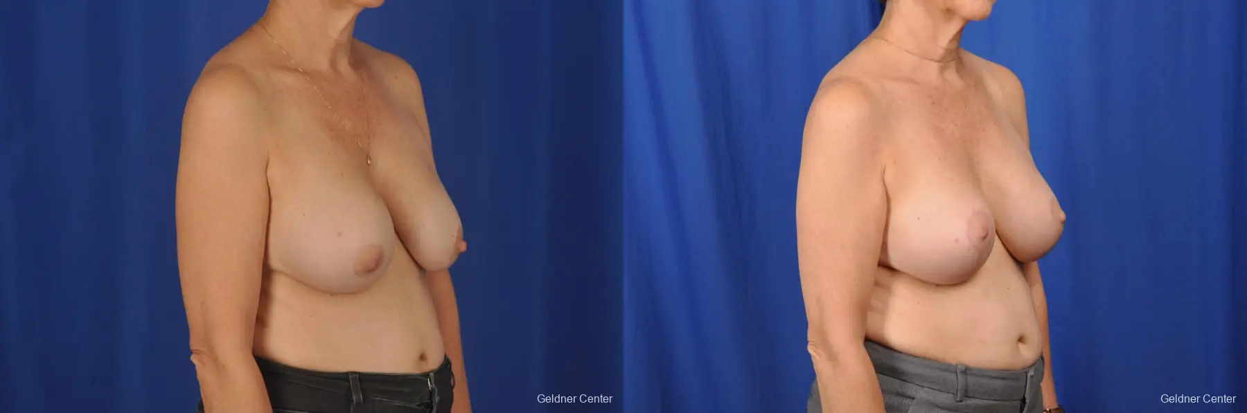 Breast Lift Hinsdale, Chicago 2058 - Before and After 3