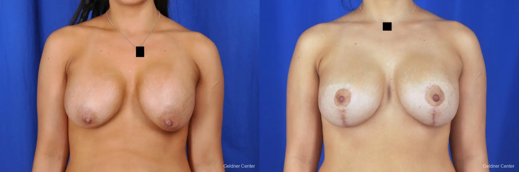 Chicago Breast Lift 2059 - Before and After 1