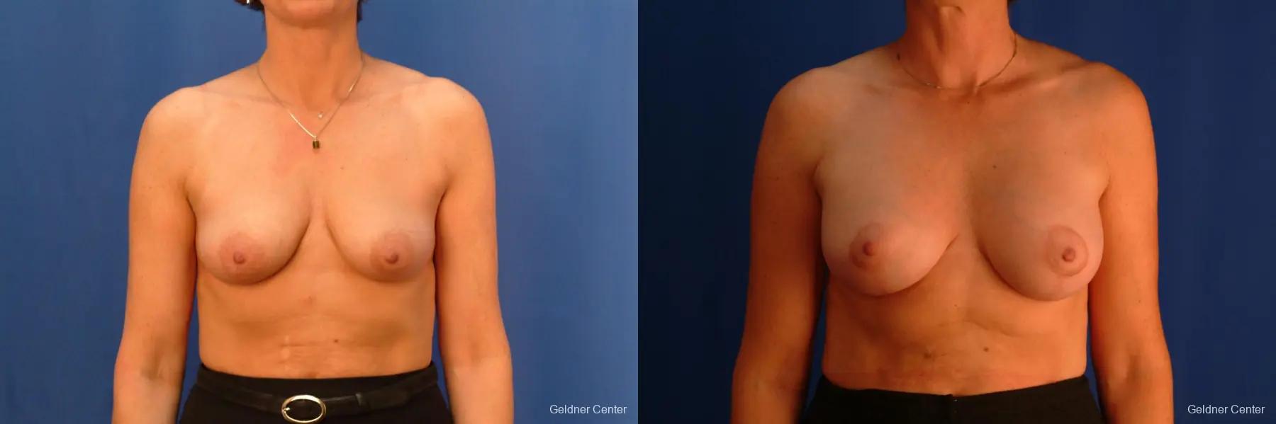 Breast Lift Hinsdale, Chicago 2509 - Before and After 1