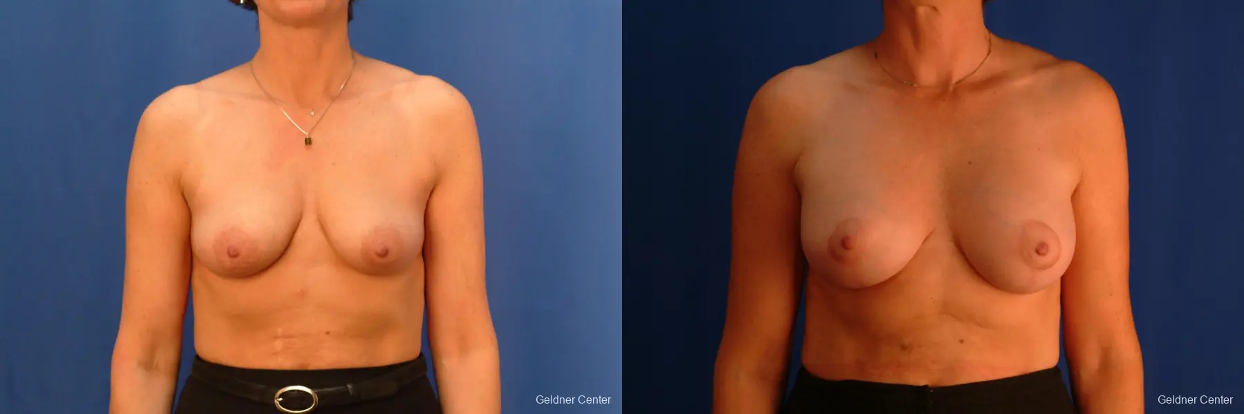 Breast Lift Hinsdale, Chicago 2509 - Before and After