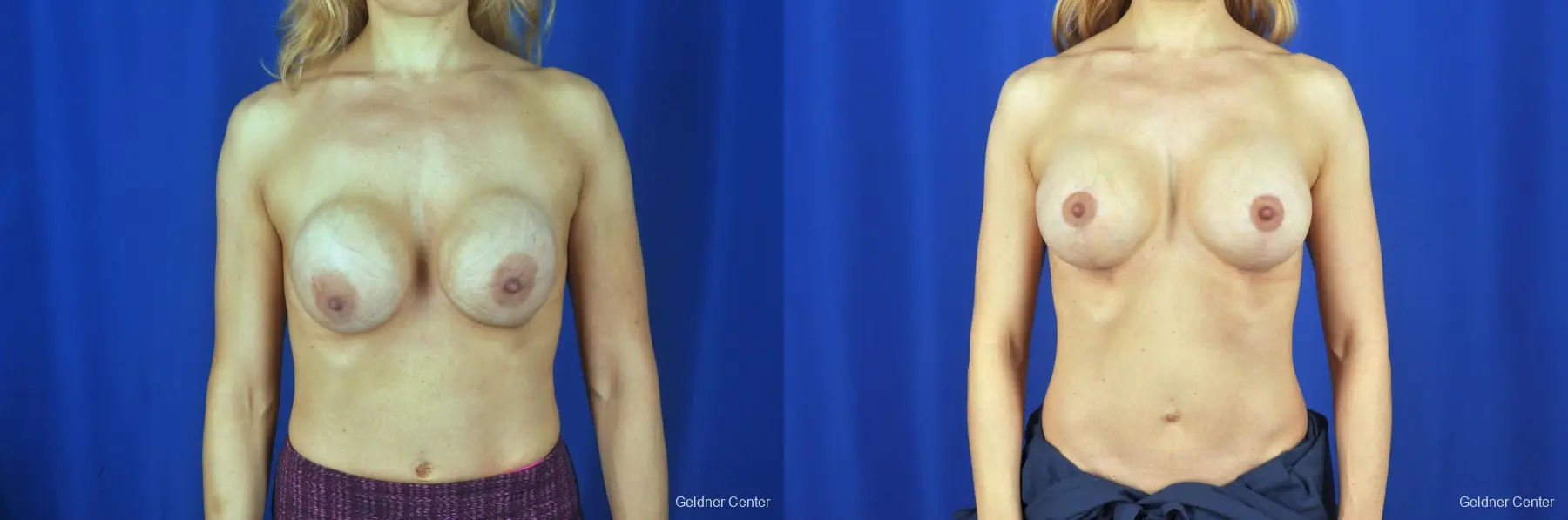 Chicago Breast Lift 2072 - Before and After 1