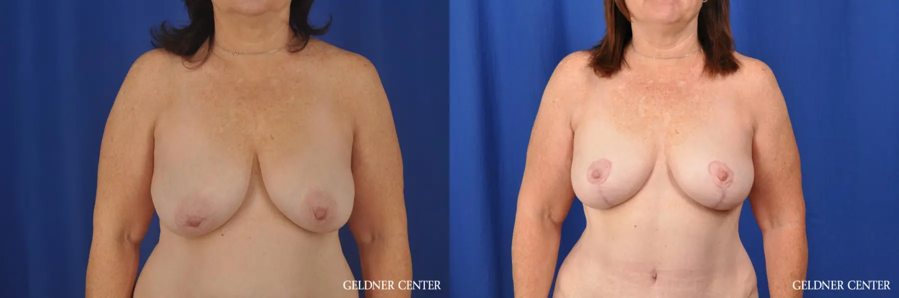 Breast Lift Hinsdale, Chicago 3232 - Before and After 1