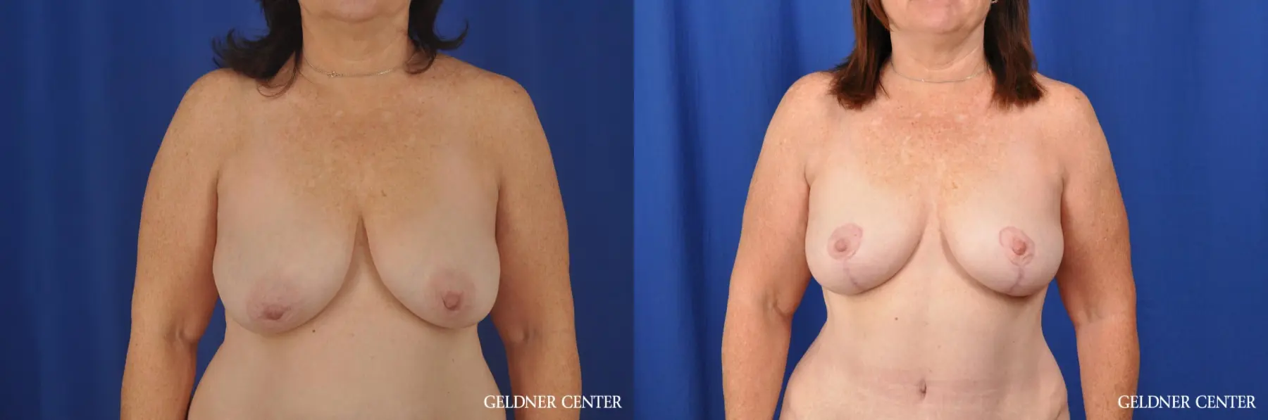 Breast Lift Hinsdale, Chicago 3232 - Before and After