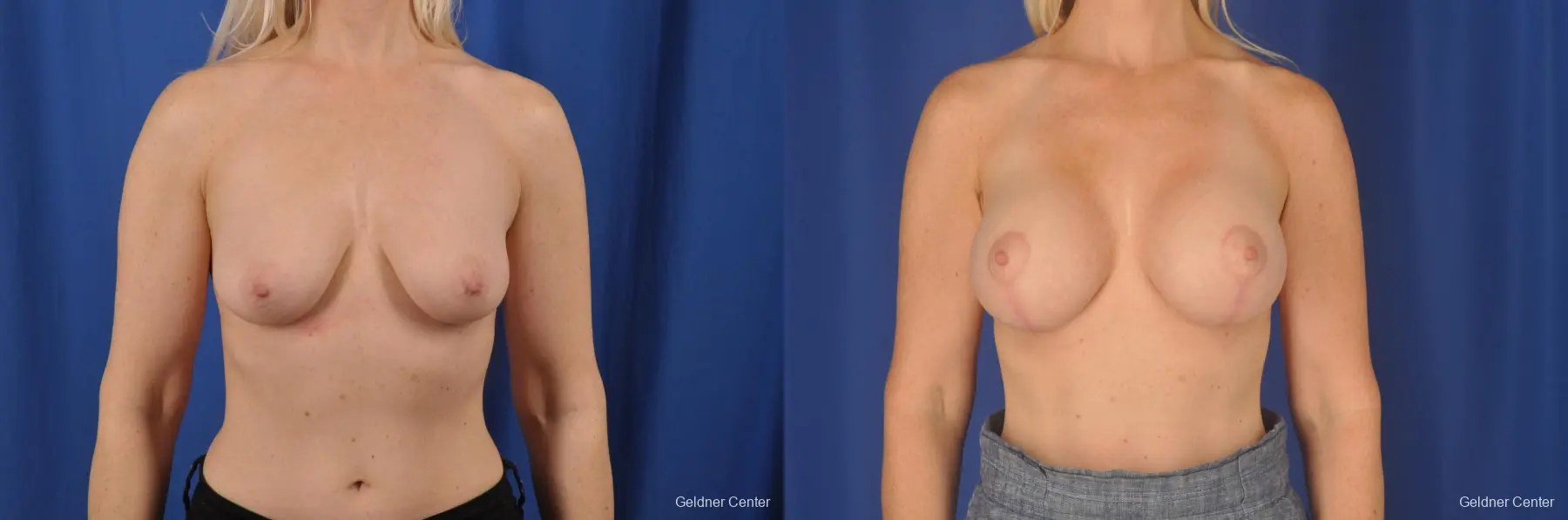 Breast Lift: Patient 19 - Before and After  