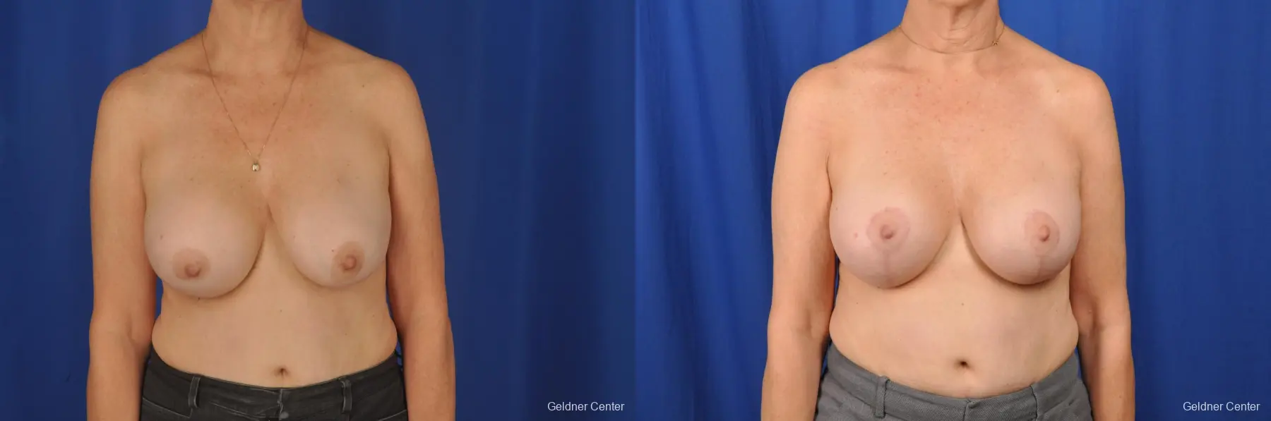 Breast Lift Hinsdale, Chicago 2058 - Before and After 1