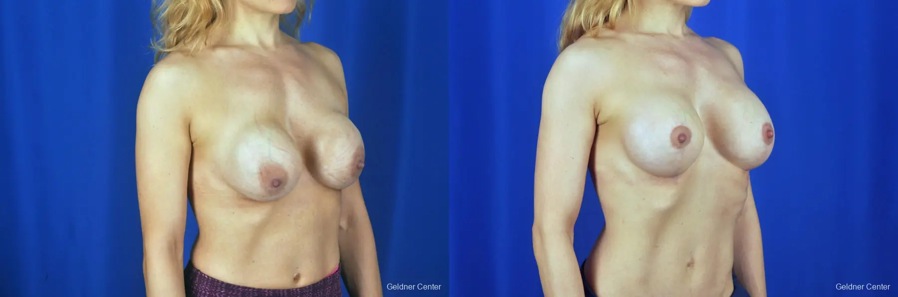 Chicago Breast Lift 2072 - Before and After 3