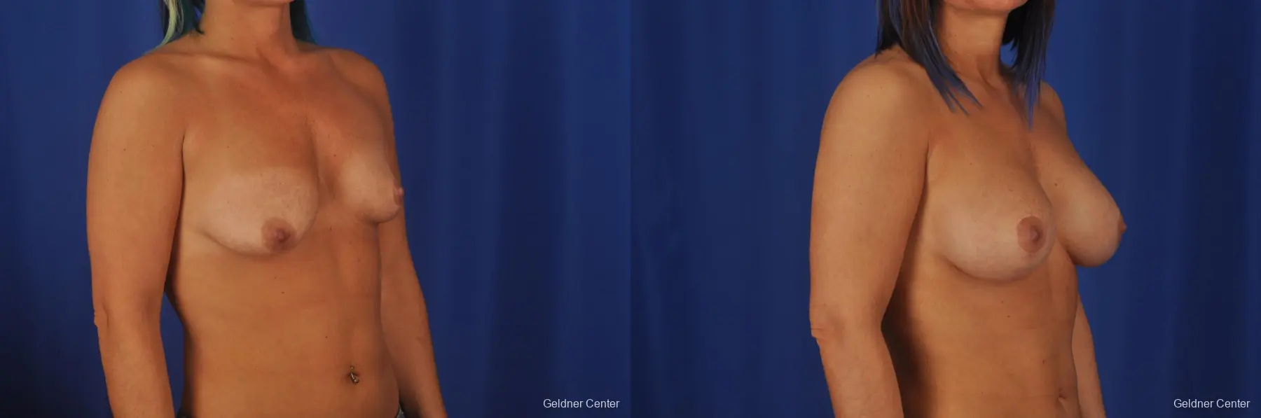 Breast Lift Lake Shore Dr, Chicago 2337 - Before and After 3