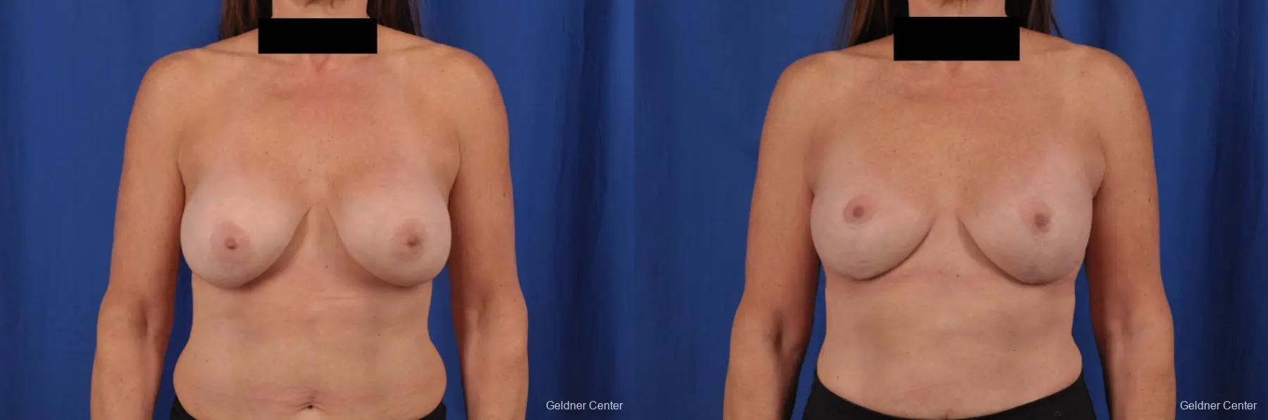 Breast Lift: Patient 43 - Before and After 1