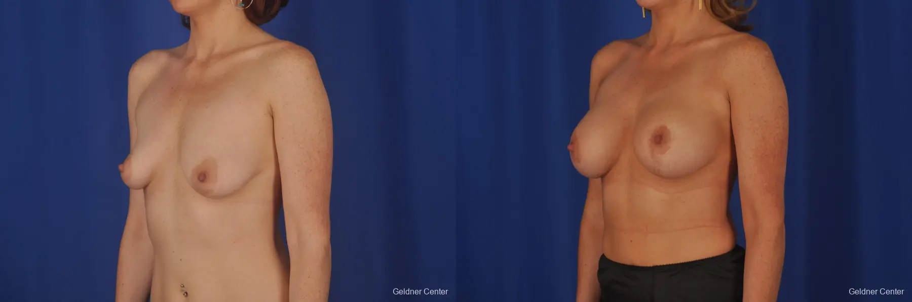 Chicago Breast Lift 2401 - Before and After 3
