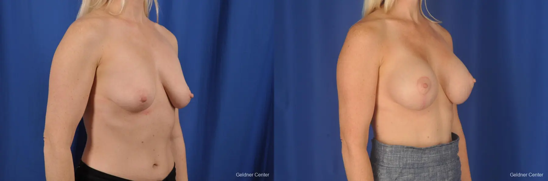 Breast Lift: Patient 19 - Before and After 3