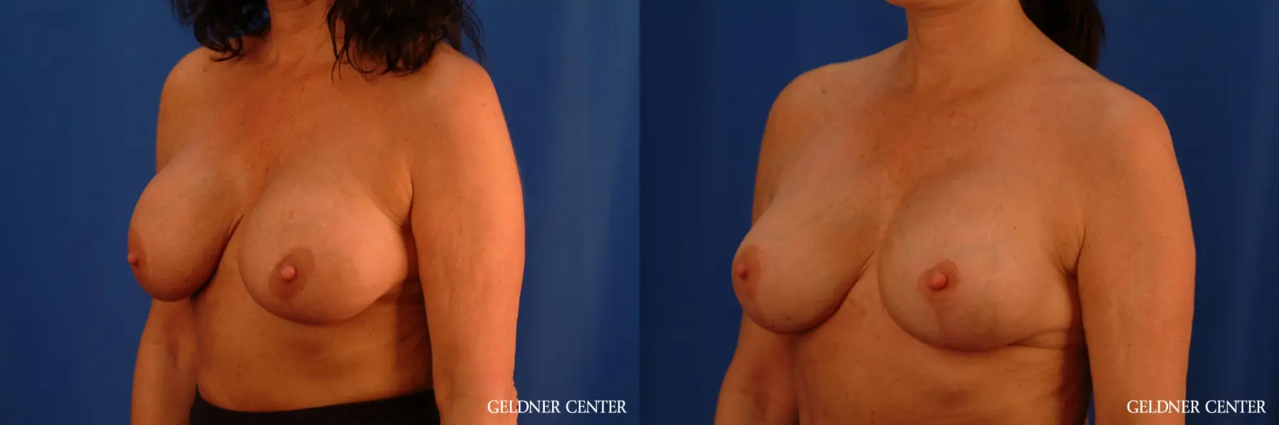 Chicago Breast Lift 2617 - Before and After 5