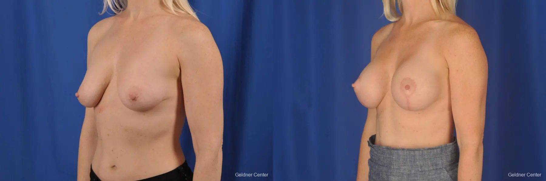 Breast Lift: Patient 19 - Before and After 4