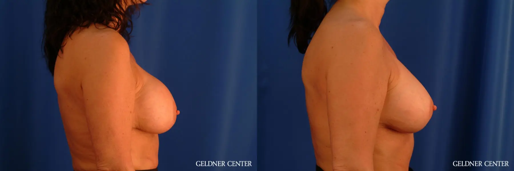 Chicago Breast Lift 2617 - Before and After 2