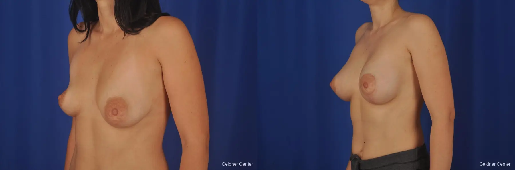 Breast Lift Lake Shore Dr, Chicago 2307 - Before and After 3