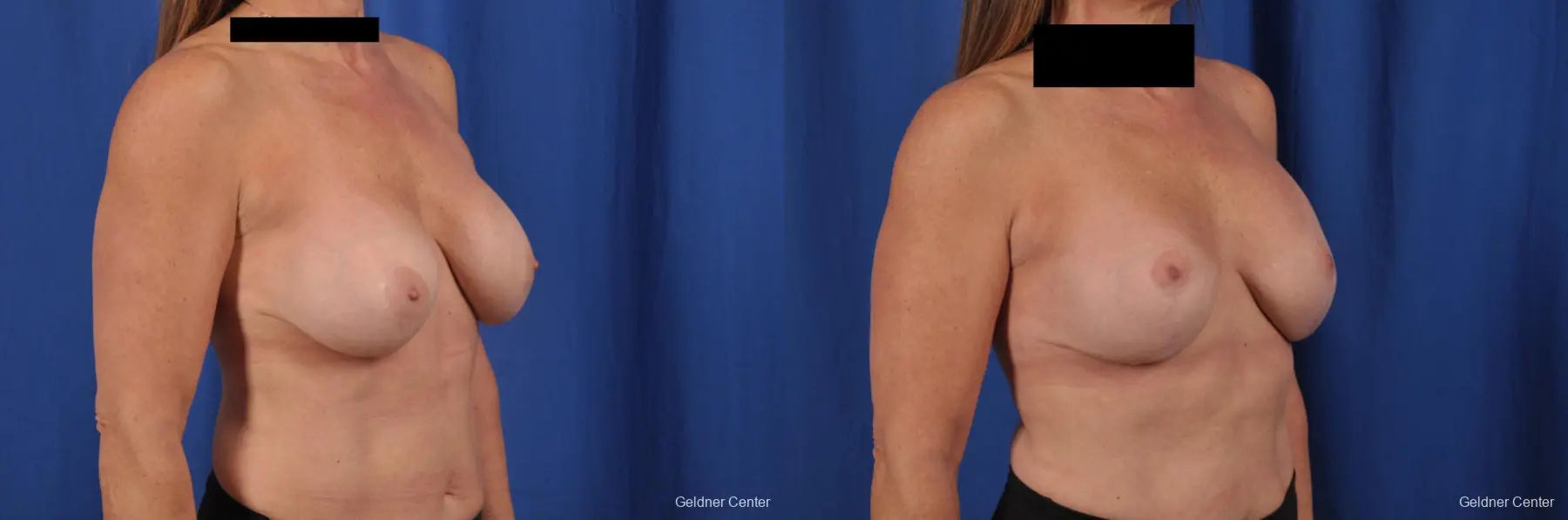 Breast Lift: Patient 43 - Before and After 3