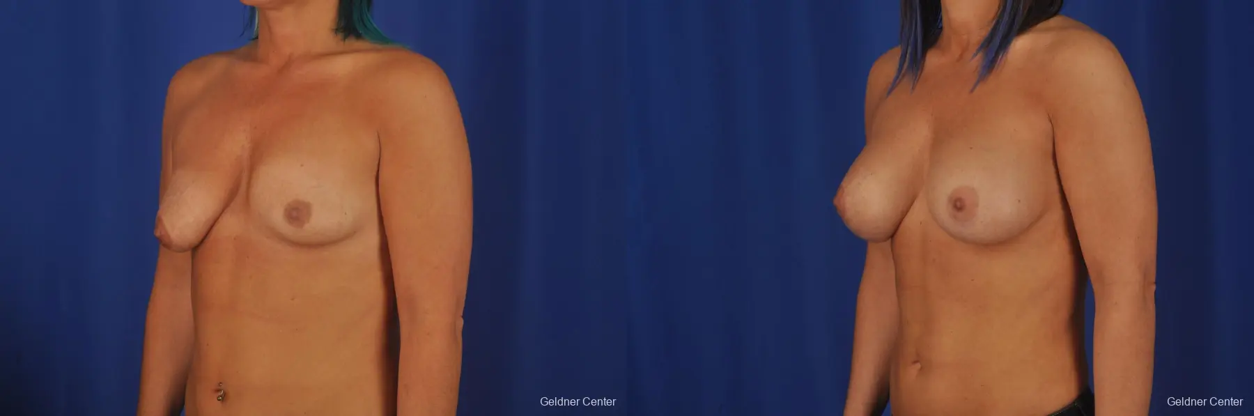 Breast Lift Lake Shore Dr, Chicago 2337 - Before and After 5