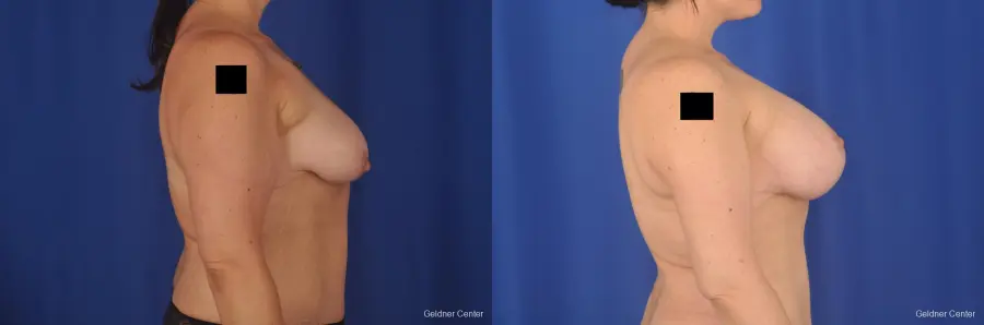 Breast Lift: Patient 18 - Before and After 3