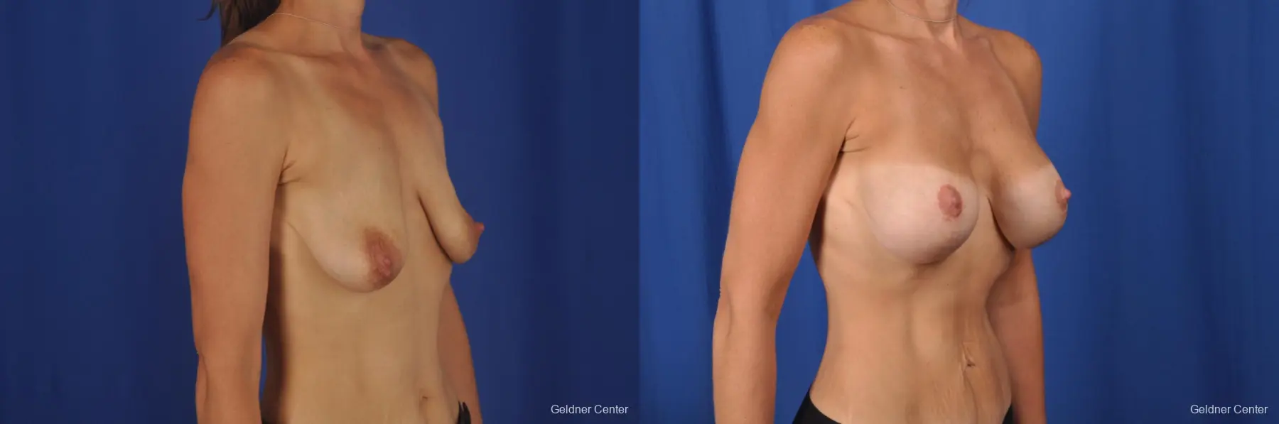 Breast Lift: Patient 45 - Before and After 2