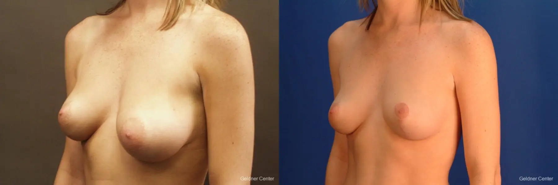 Chicago Breast Lift 2537 - Before and After 4