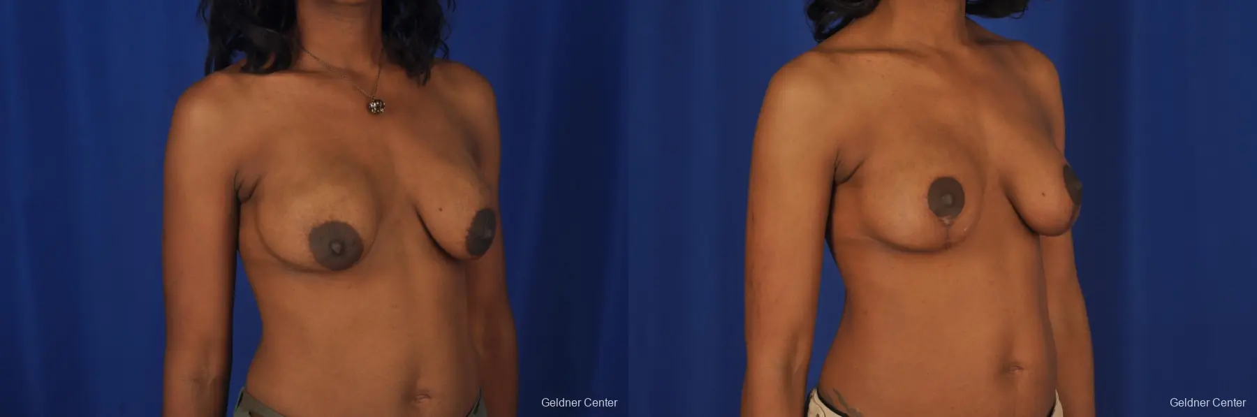 Breast Lift Streeterville, Chicago 2379 - Before and After 4
