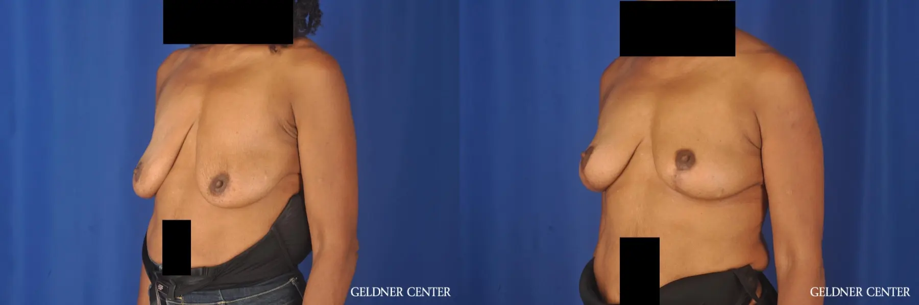 Breast Lift: Patient 22 - Before and After 4