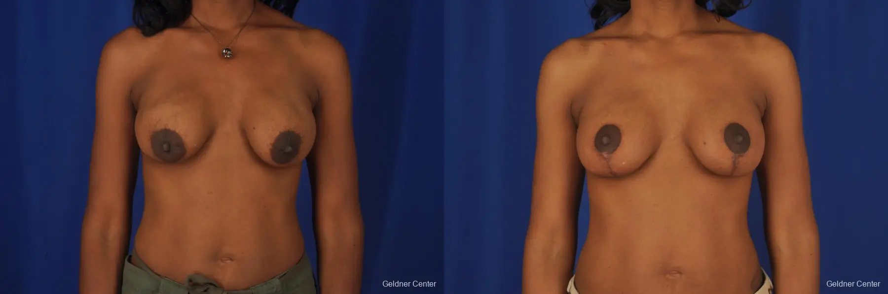 Breast Lift Streeterville, Chicago 2379 - Before and After 1