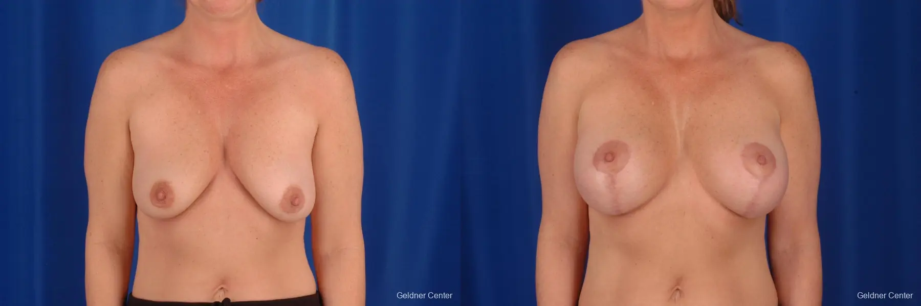 Breast Lift Lake Shore Dr, Chicago 2308 - Before and After 1