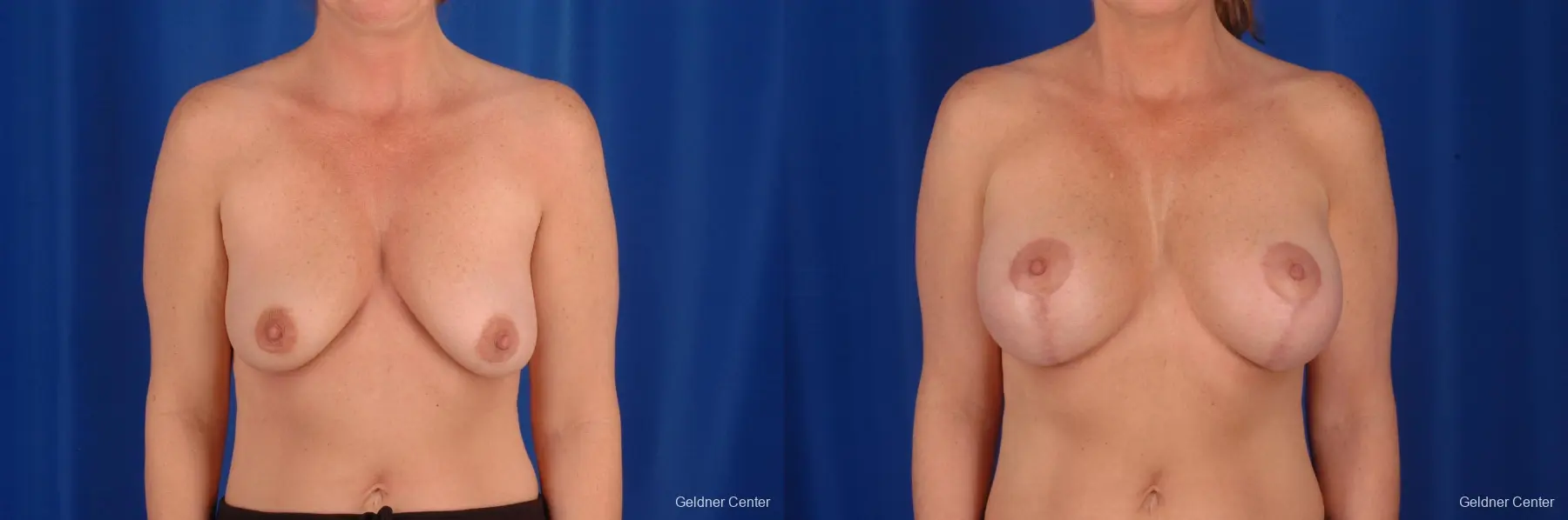 Breast Lift Lake Shore Dr, Chicago 2308 - Before and After