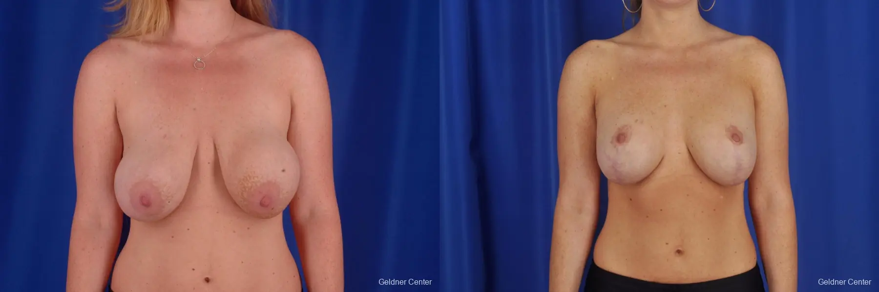 Chicago Breast Lift 2291 - Before and After