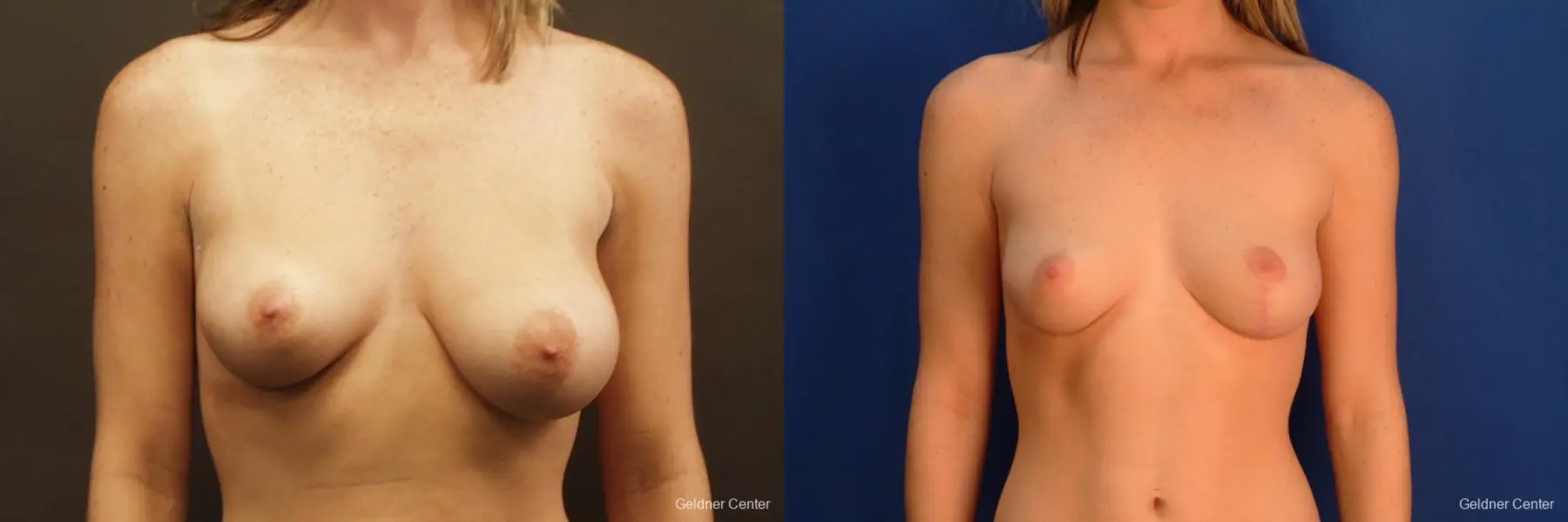 Chicago Breast Lift 2537 - Before and After 1