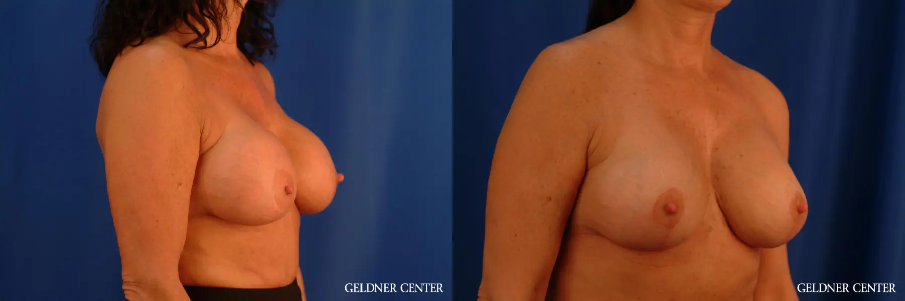 Chicago Breast Lift 2617 - Before and After 3