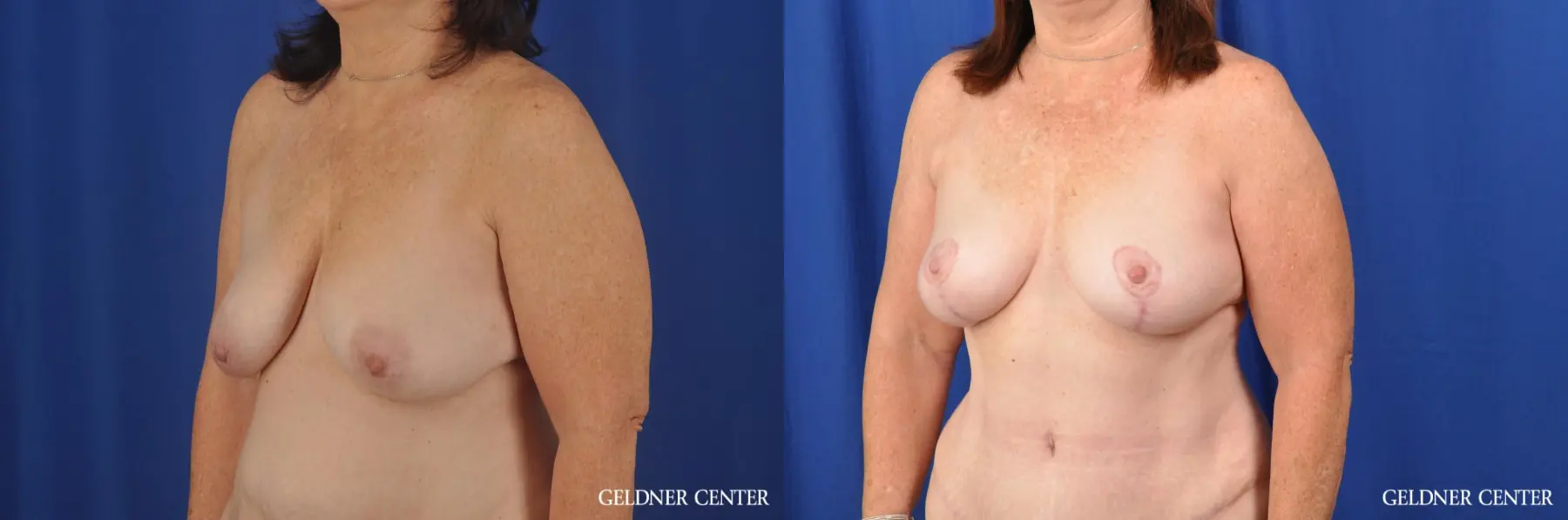 Breast Lift Hinsdale, Chicago 3232 - Before and After 4